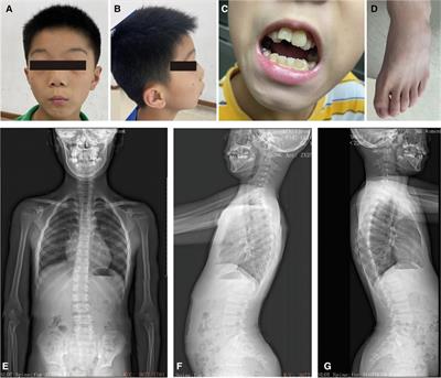 Case Report: Identification of a novel PRR12 variant in a Chinese boy with developmental delay and short stature